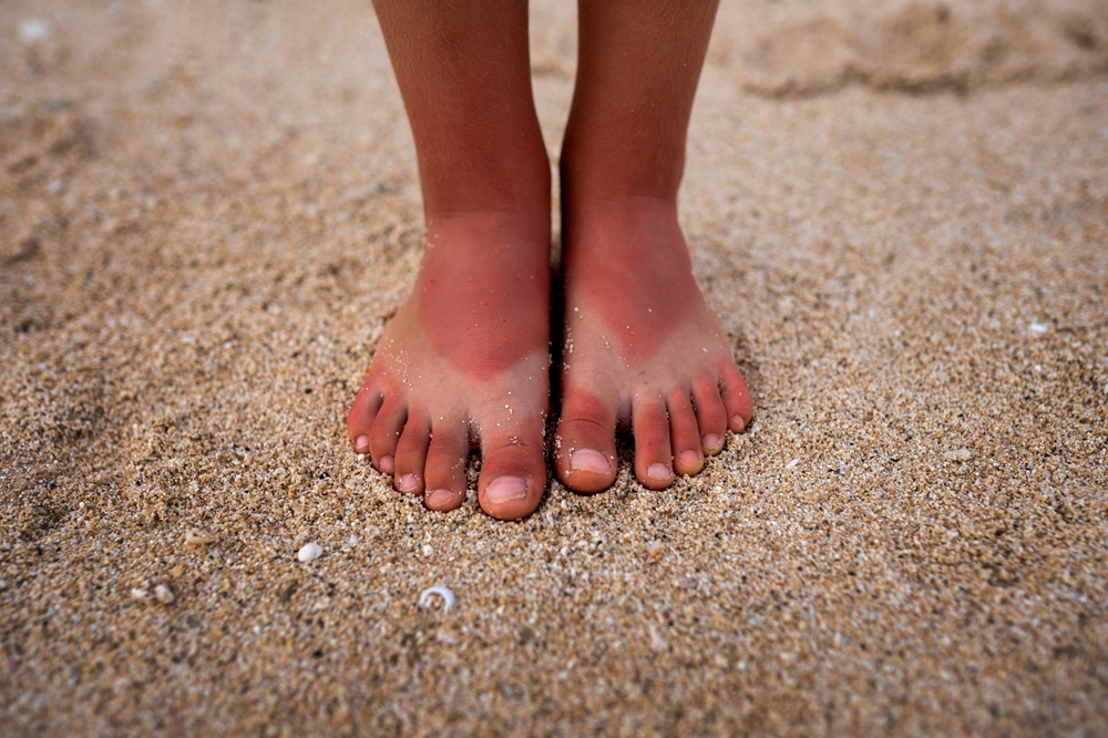 Close-up of a person's sunburned feet in the sand.